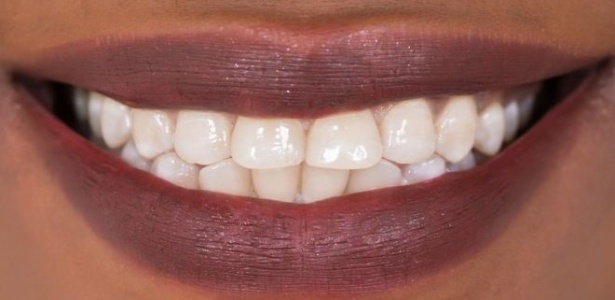 Cientistas britânicos criam substância que pode regenerar dentes e aposentar obturações 8