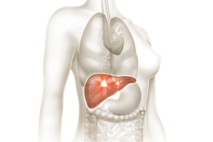 Colangite biliar primária, a doença do fígado que causa coceira e fadiga 5