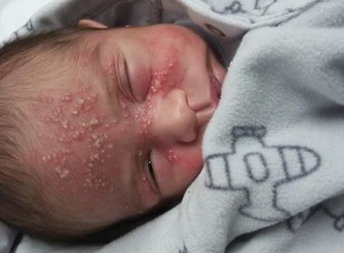 Após filho de 17 dias contrair herpes, mãe alerta sobre risco de se beijar bebês 5