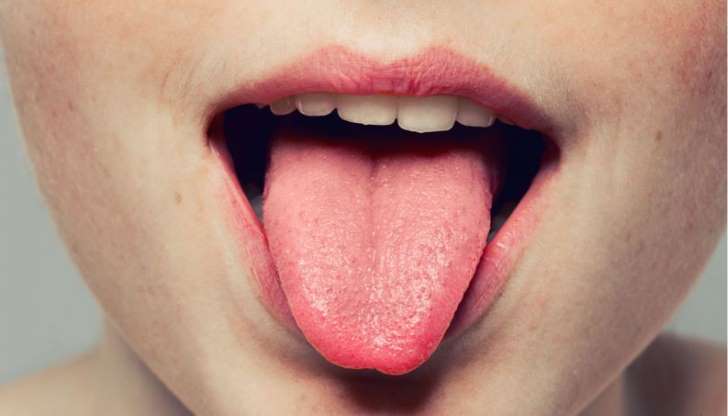 Língua muito vermelha pode ser sinal de anemia, candidíase e mais 2 problemas 5