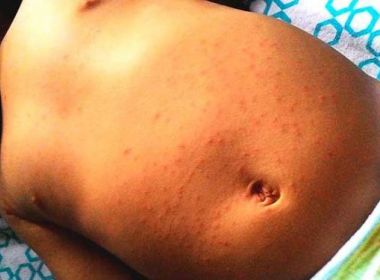 Especialistas alertam para epidemias de Zika e Chikungunya no verão 10