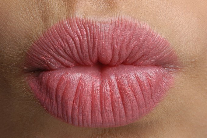 Câncer de pele pode atingir os lábios. Quais as causas e os tratamentos? 5
