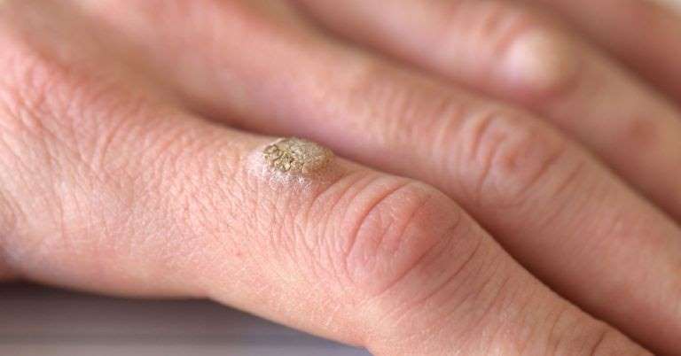 É verdade que verrugas são contagiosas? Saiba tipos, riscos e como sumir com elas 5