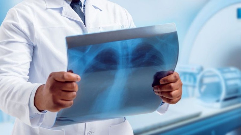 Covid-19: exame pioneiro mostra danos em pulmões 3 meses depois de infecção por coronavírus 5