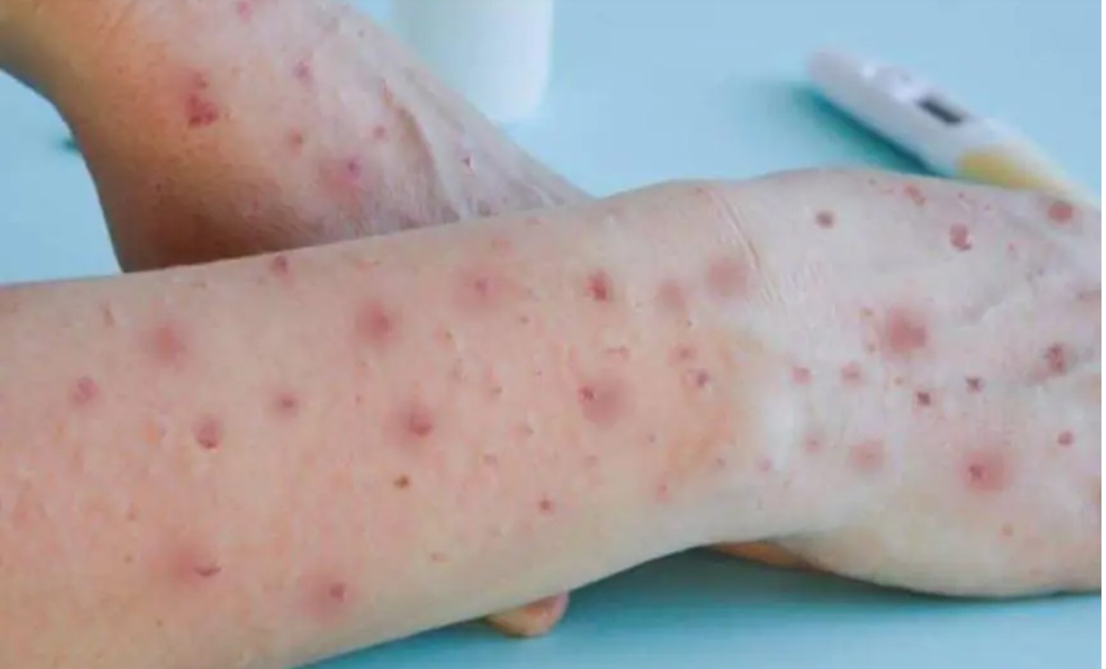 Governador Valadares tem primeiro caso de varíola dos macacos confirmado 5