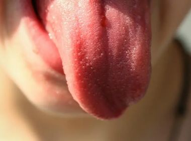 Síndrome da boca ardente: doença intriga médicos e não tem cura 3