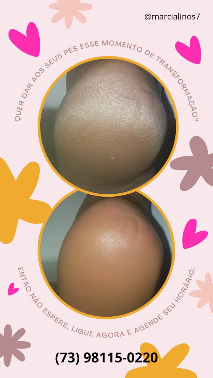 Atenção!!! Homens e Mulheres vocês sabiam que os pés deveriam ser um dos principais pontos de atenção em se tratando do bem-estar? 7