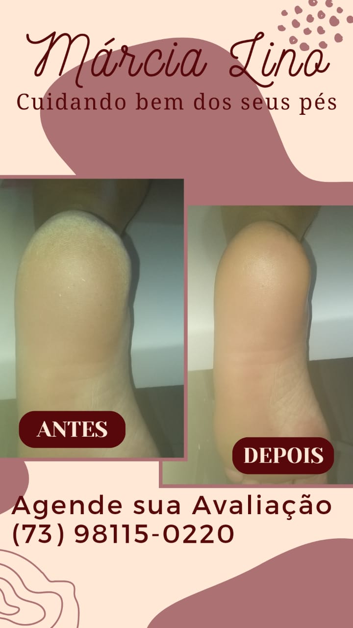 Atenção!!! Homens e Mulheres vocês sabiam que os pés deveriam ser um dos principais pontos de atenção em se tratando do bem-estar? 6