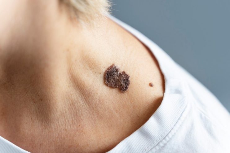Dermatologista alerta para cuidados contra o câncer de pele no verão 4