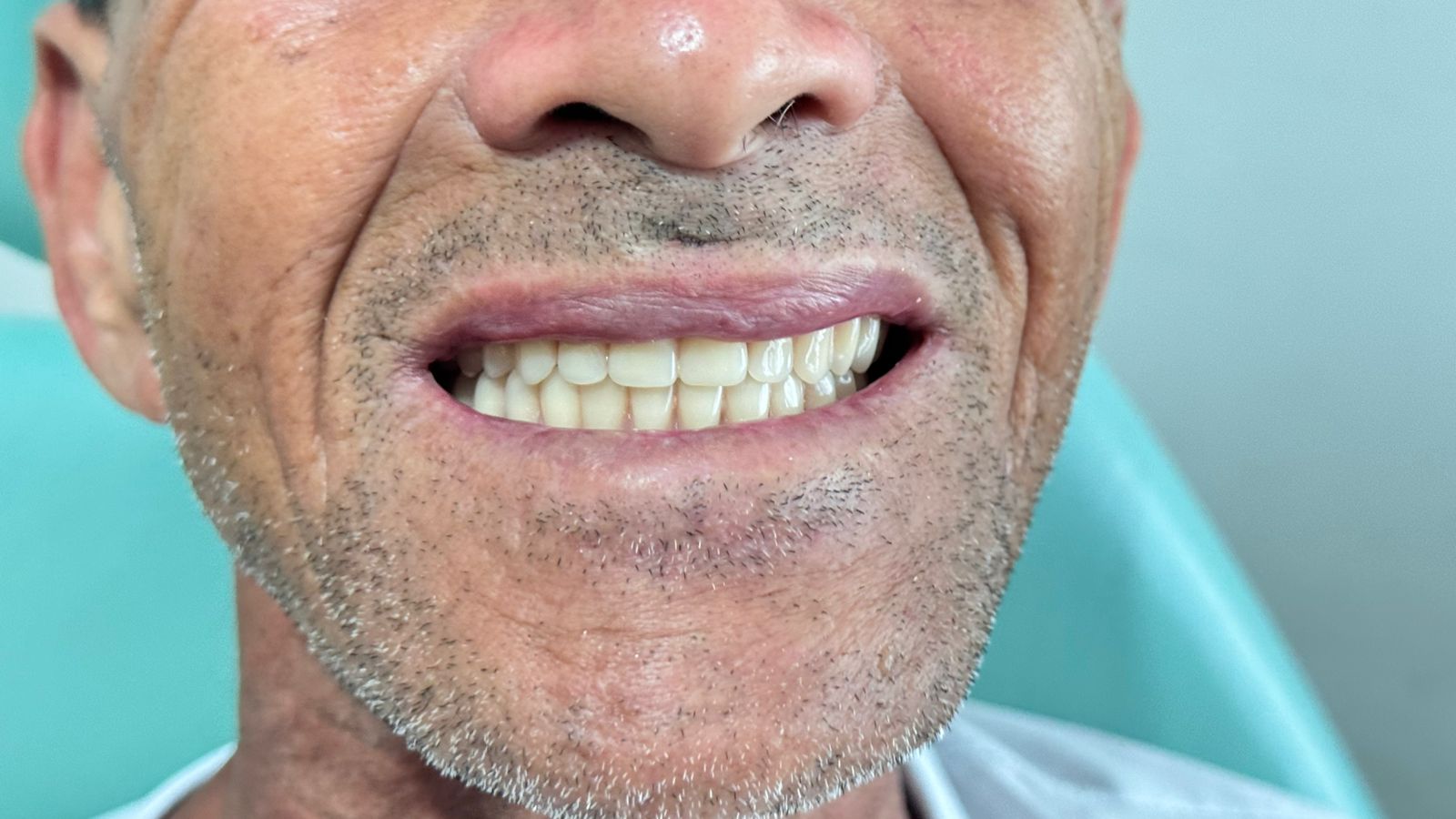 Programa Voltando a Sorrir beneficia centenas de moradores com a entrega de próteses dentárias em Itagimirim 5