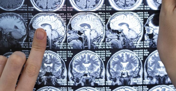 Cerca de 40 mil pessoas vivem com esclerose múltipla no Brasil, diz pesquisa 4