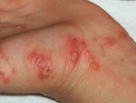 Guaratinga registra aumento de casos de escabiose e intensifica ações de saúde Guaratinga registra aumento de casos de escabiose e intensifica ações de saúde 6