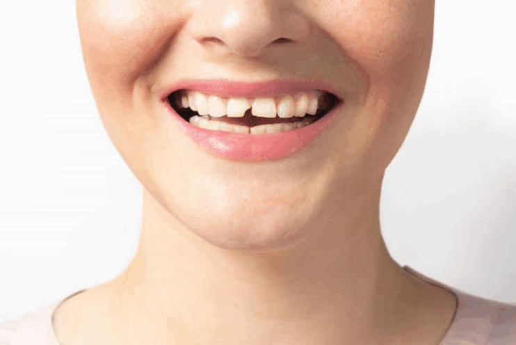 Os hábitos que mais prejudicam os dentes sem você perceber e como evitá-los 10