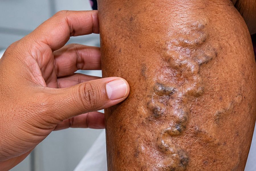 Prefeitura de Eunápolis inicia mutirão inédito para tratamento de varizes que beneficiará mais de 600 pacientes 5