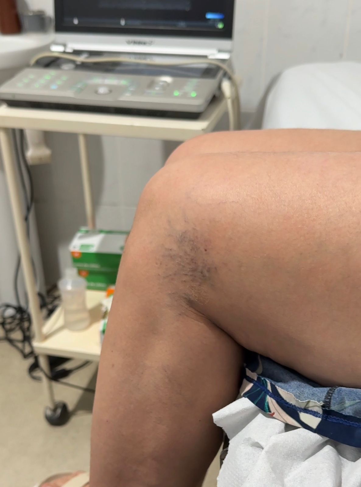 Prefeitura de Eunápolis realiza segunda etapa da escleroterapia 5